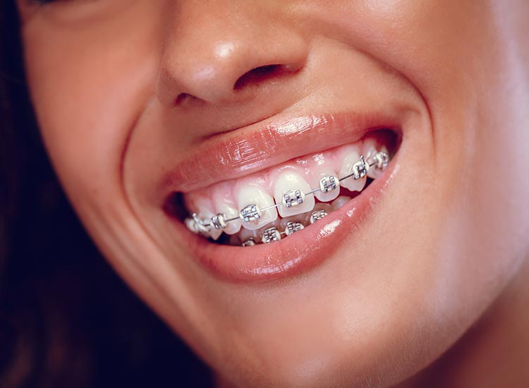 person smiling with braces