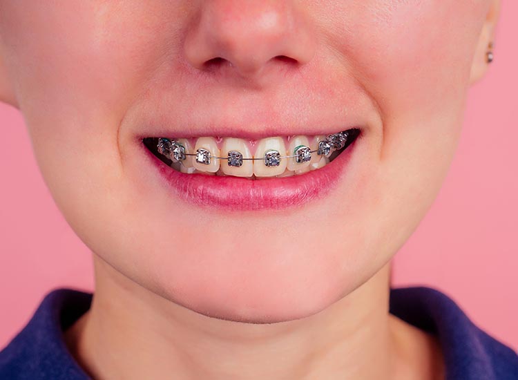 child smiling with braces
