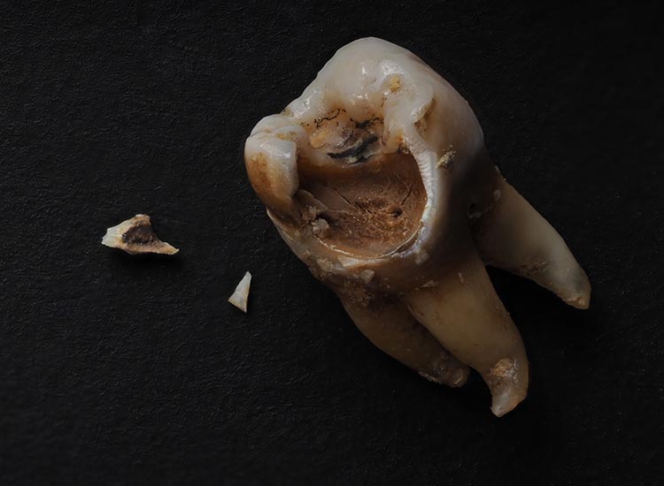 a decayed tooth