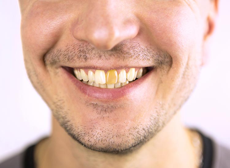 person with a yellow tooth