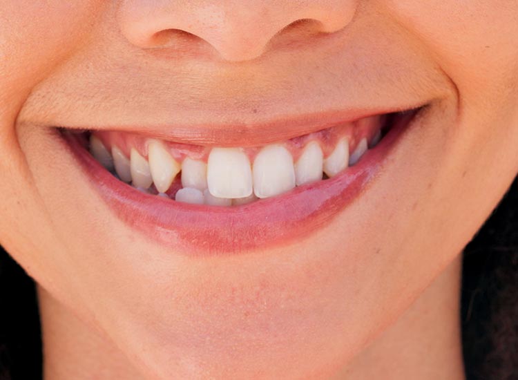person with a broken tooth