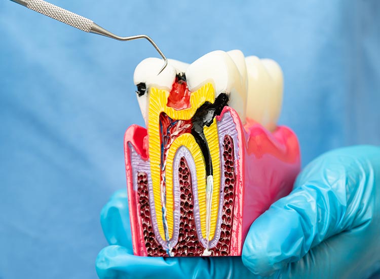 root canal model with cavity