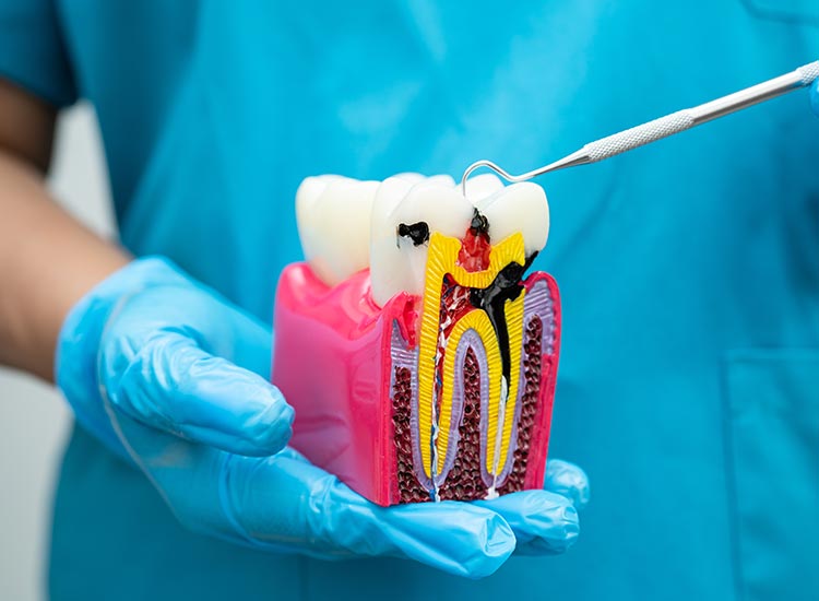 root canal model with cavity in it