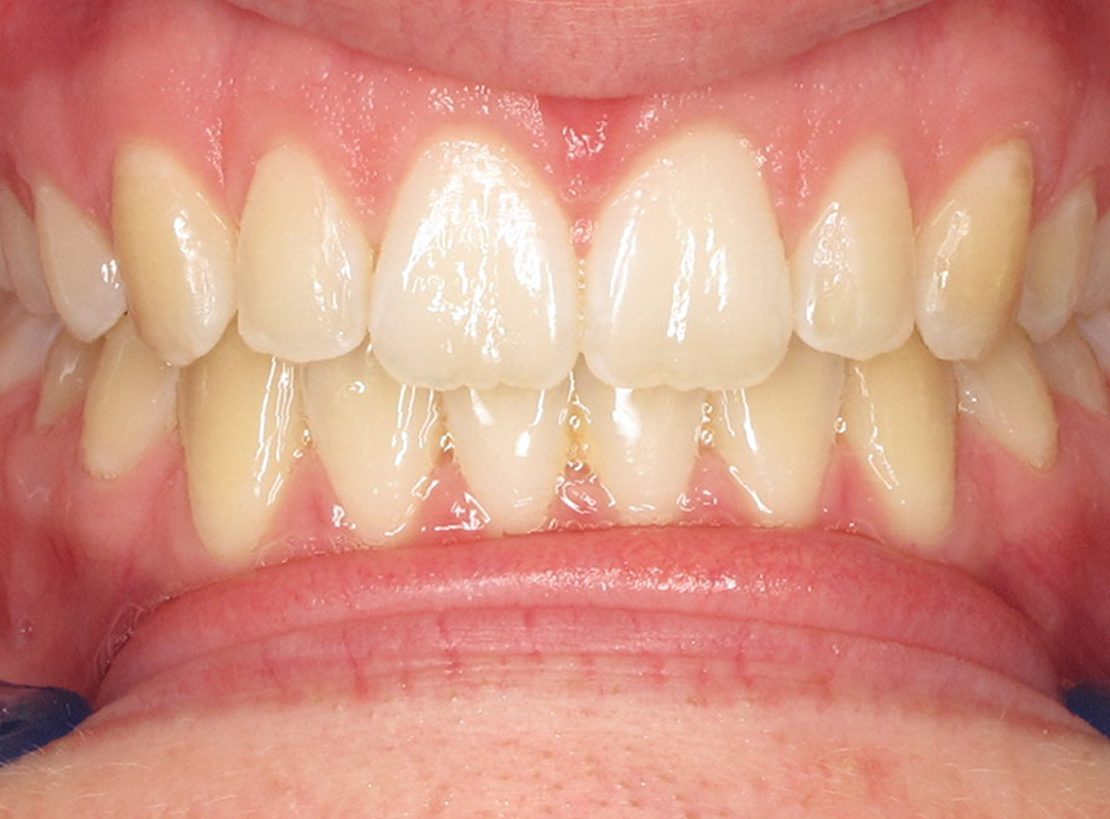 teeth after photo