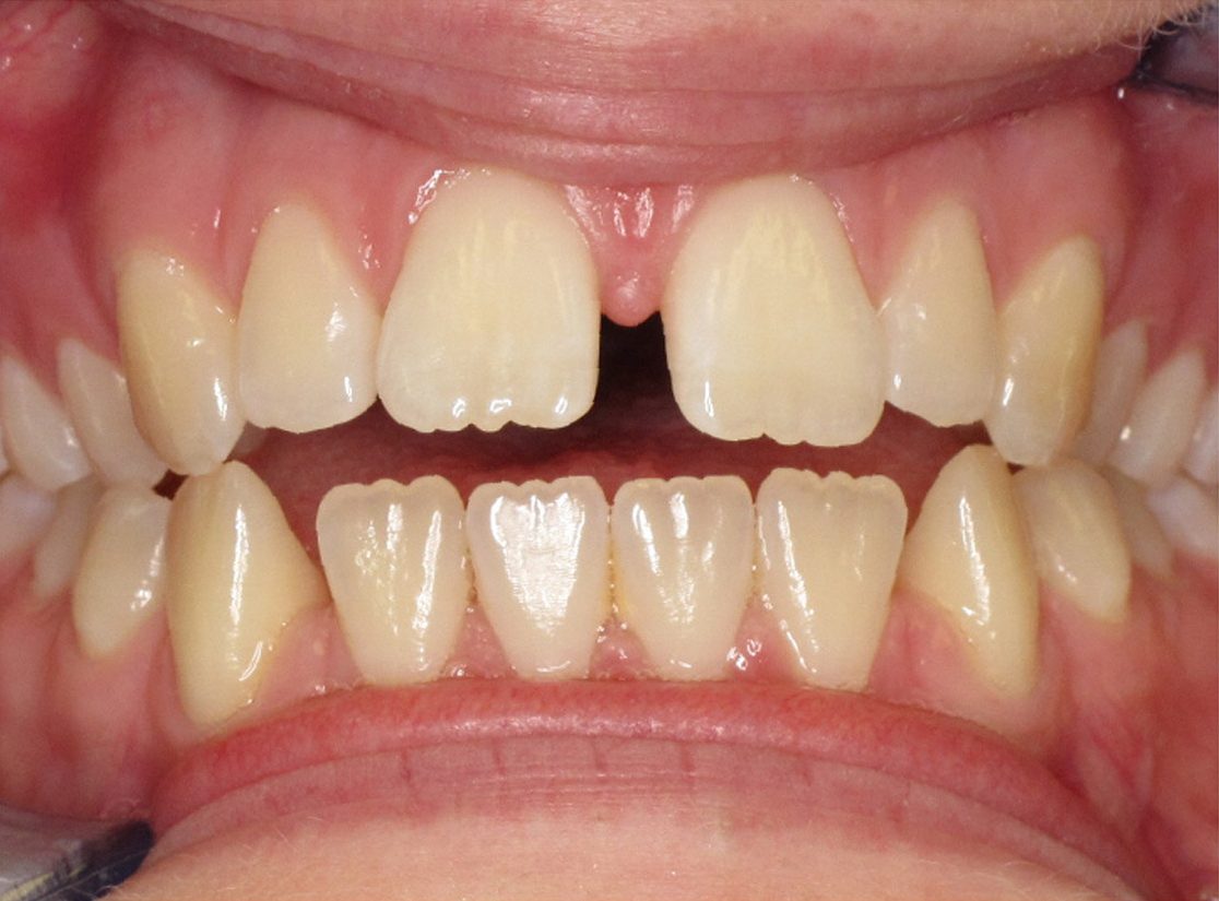 teeth before photo