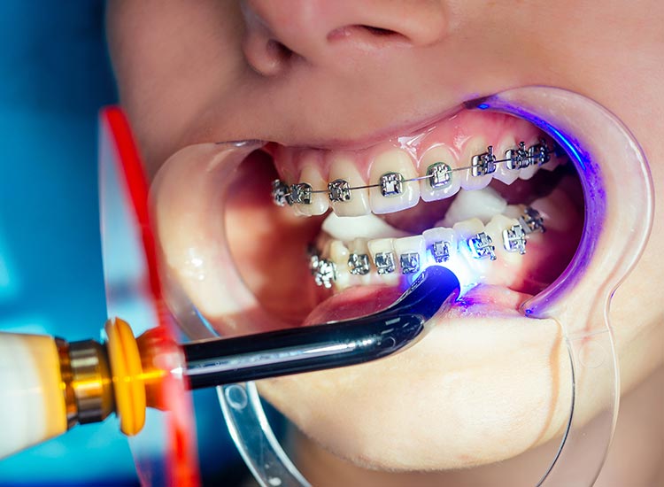 dentist working patients braces